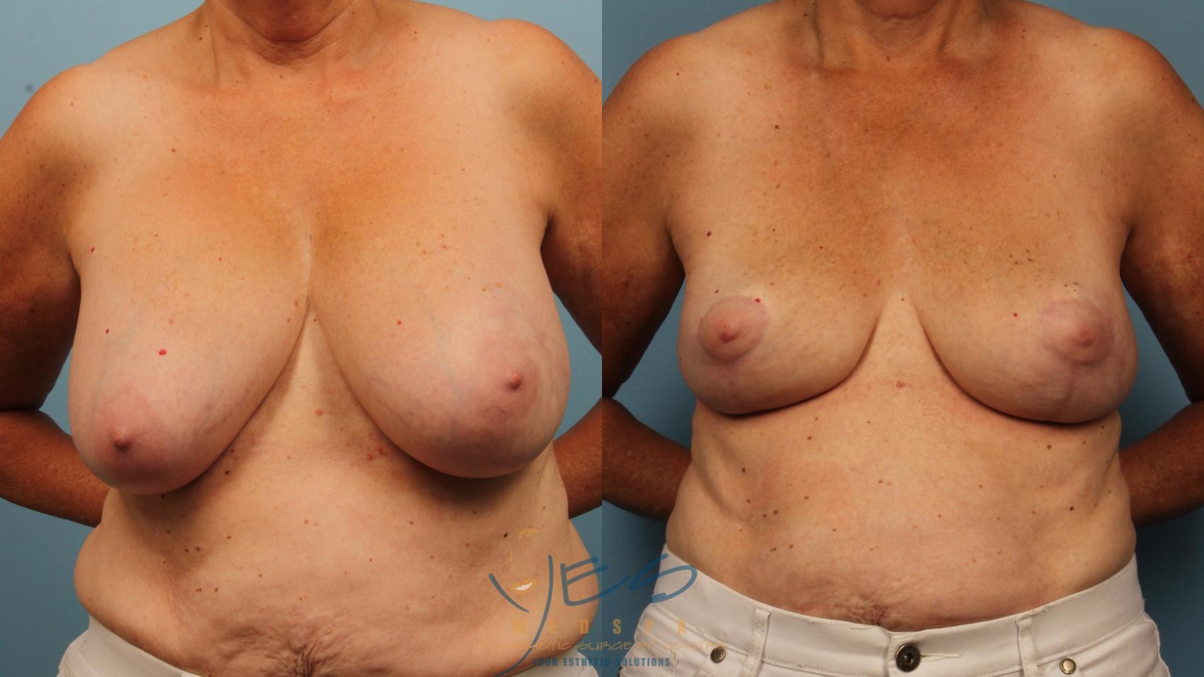 Before & After Breast Implant Removal Case 366 Front View in Vancouver, BC