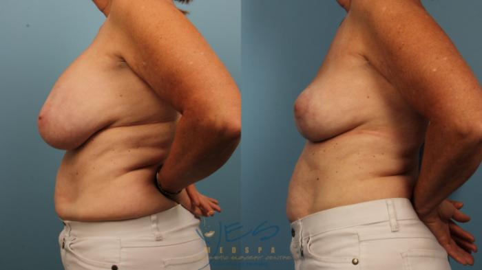 Before & After Breast Lift Case 366 Left Side View in Vancouver, BC
