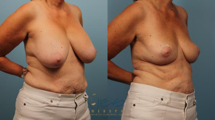 Before & After Breast Implant Removal Case 366 Right Oblique View in Vancouver, BC