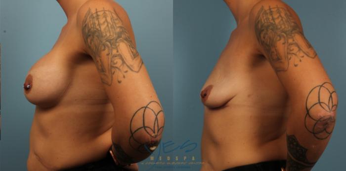 Before & After Breast Implant Removal Case 432 Left Side View in Vancouver, BC