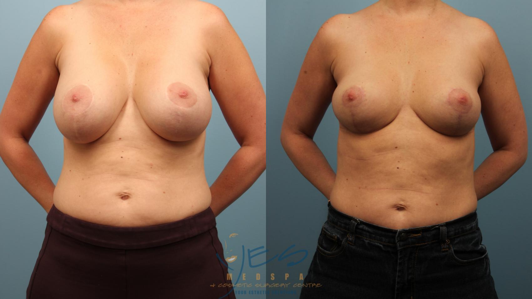 Before & After Breast Implant Removal Case 468 Front View in Vancouver, BC