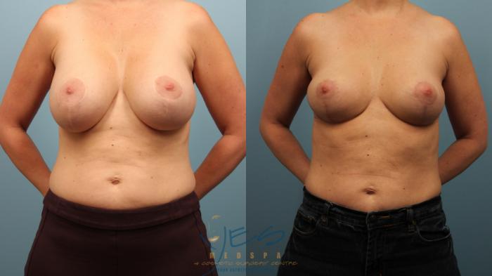 Before & After Breast Lift Case 468 Front View in Vancouver, BC
