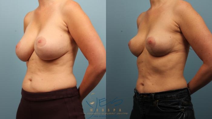 Before & After Breast Implant Removal Case 468 Left Oblique View in Vancouver, BC