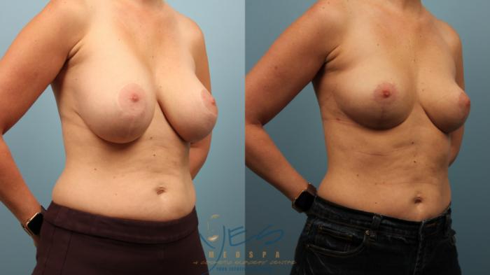 Before & After Breast Implant Removal Case 468 Right Oblique View in Vancouver, BC