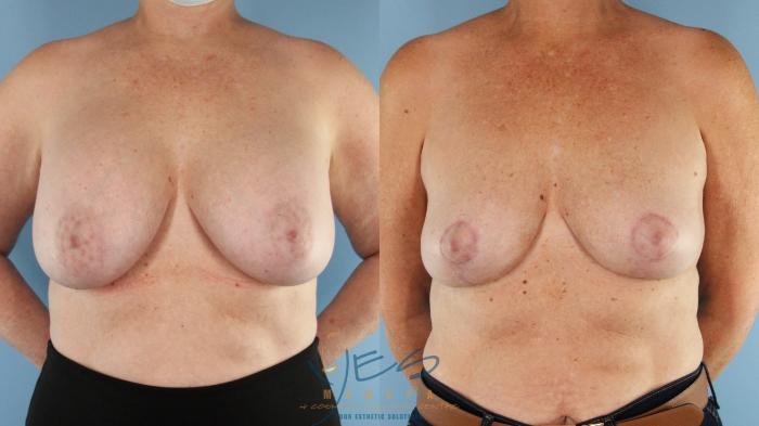 Before & After Breast Lift Case 589 Front View in Vancouver, BC