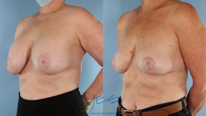 Before & After Breast Lift Case 589 Right Oblique View in Vancouver, BC