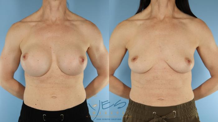 Before & After Breast Implant Removal Case 600 Front View in Vancouver, BC