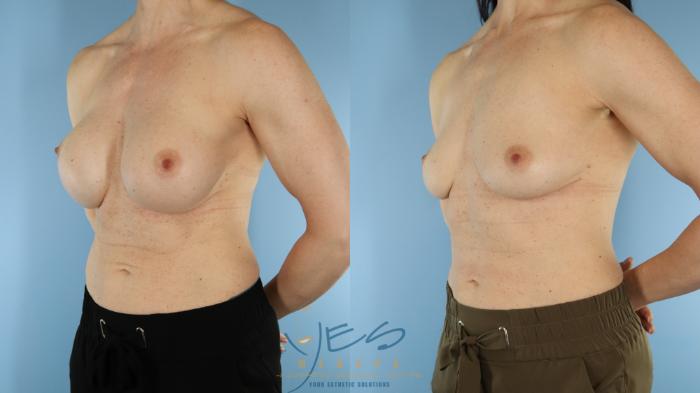 Before & After Breast Implant Removal Case 600 Left Oblique View in Vancouver, BC
