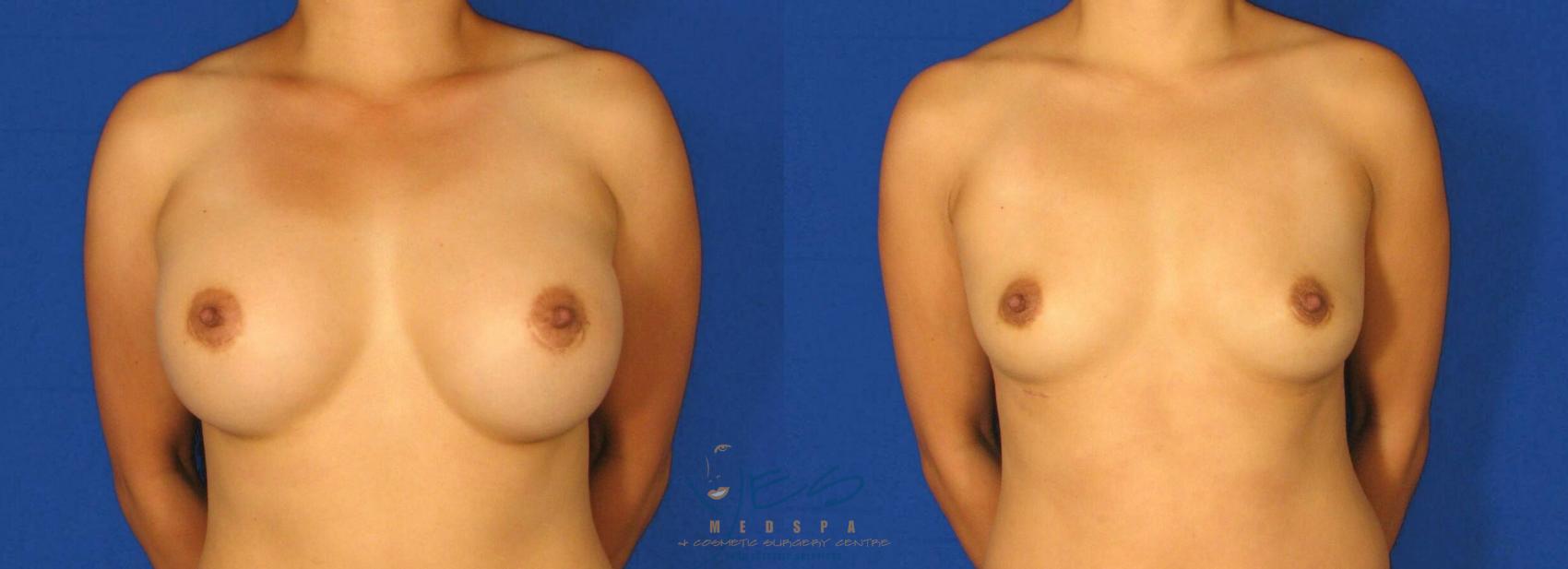 Before & After Breast Implant Removal Case 72 View #1 View in Vancouver, BC
