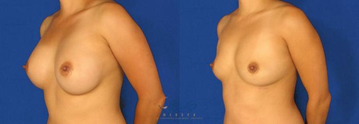 Before & After Breast Implant Removal Case 72 View #2 View in Vancouver, BC