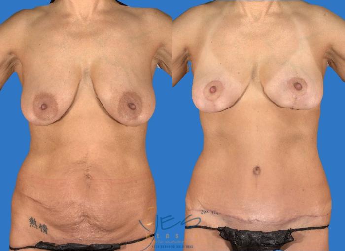 Before & After Breast Lift Case 107 View #1 View in Vancouver, BC