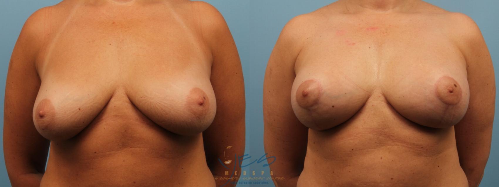 Before & After Breast Lift Case 171 View #1 View in Vancouver, BC