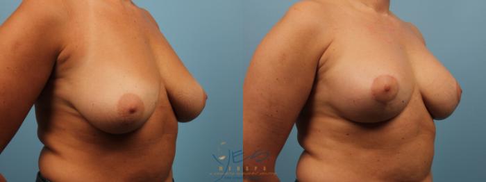 Before & After Breast Lift Case 171 View #2 View in Vancouver, BC
