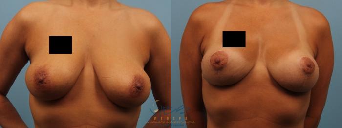 Before & After Breast Lift Case 181 View #1 View in Vancouver, BC