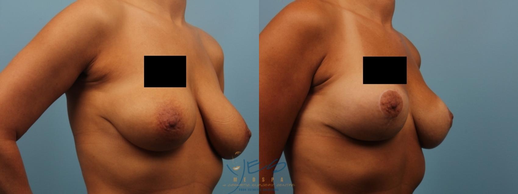 Before & After Breast Lift Case 181 View #2 View in Vancouver, BC