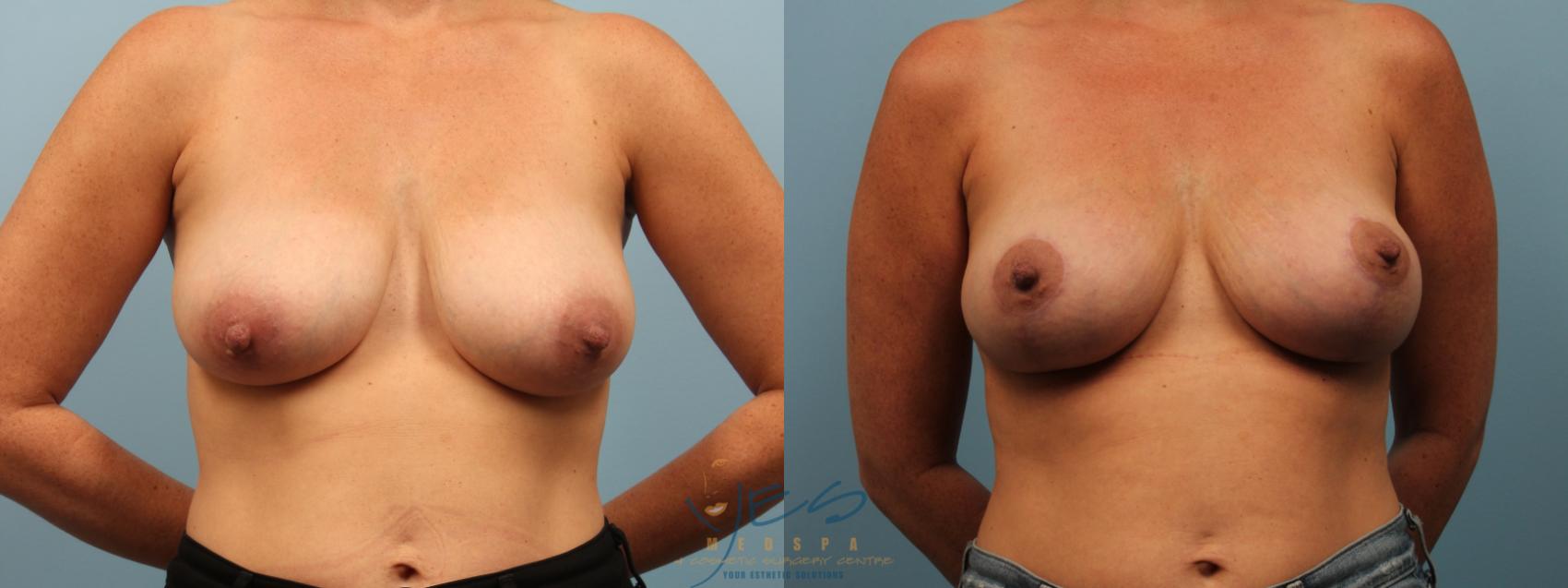 Before & After Breast Lift Case 291 Front View in Vancouver, BC