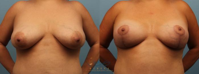 Before & After Breast Lift Case 300 Front View in Vancouver, BC