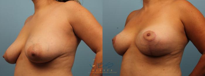 Before & After Breast Lift Case 300 Left Oblique View in Vancouver, BC