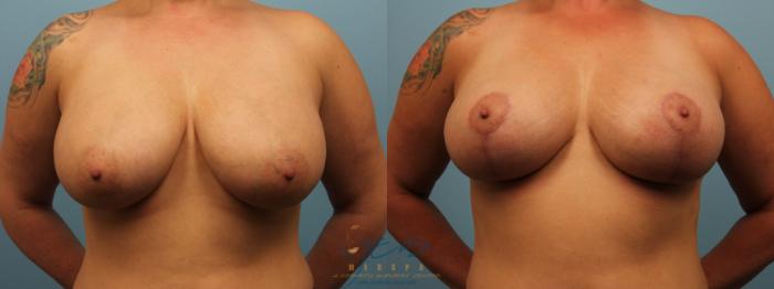 Before & After Breast Lift Case 309 Front View in Vancouver, BC