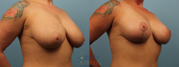 Before & After Breast Lift Case 309 Right Oblique View in Vancouver, BC