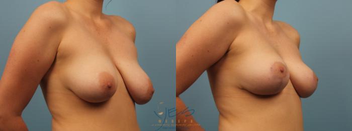 Before & After Breast Lift Case 314 Right Oblique View in Vancouver, BC