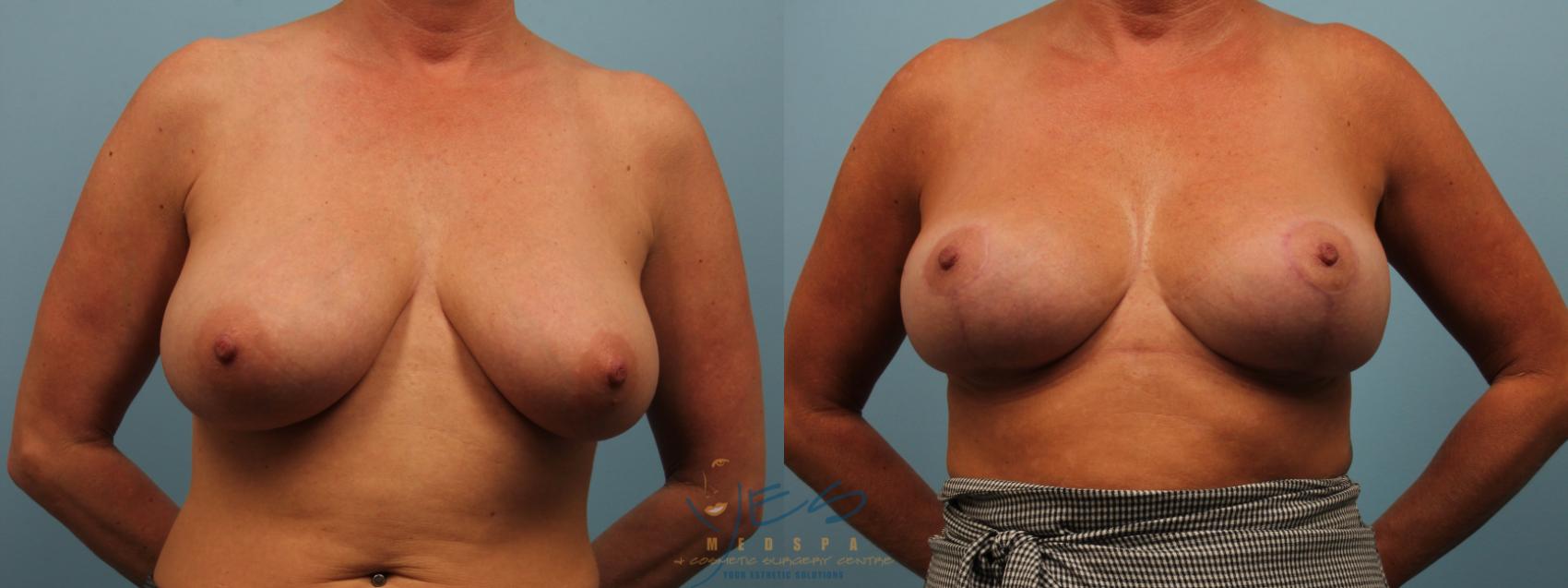 Before & After Breast Lift Case 323 Front View in Vancouver, BC