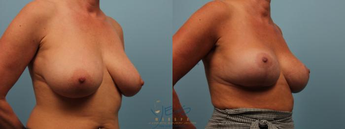 Before & After Breast Lift Case 323 Right Oblique View in Vancouver, BC