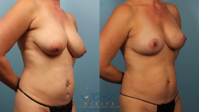 Before & After Liposuction Case 375 Right Oblique View in Vancouver, BC