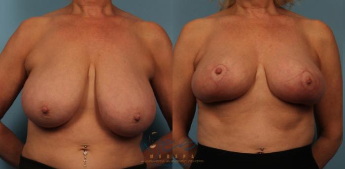 Before & After Breast Lift Case 429 Front View in Vancouver, BC