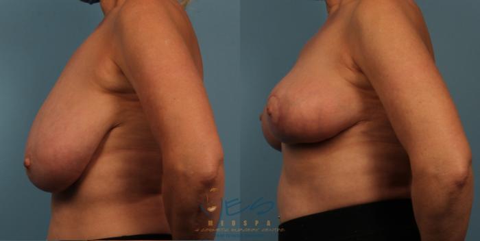 Before & After Breast Lift Case 429 Left Side View in Vancouver, BC
