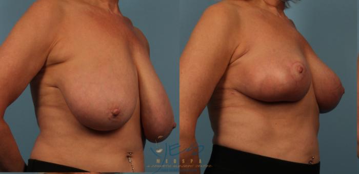 Before & After Breast Lift Case 429 Right Oblique View in Vancouver, BC