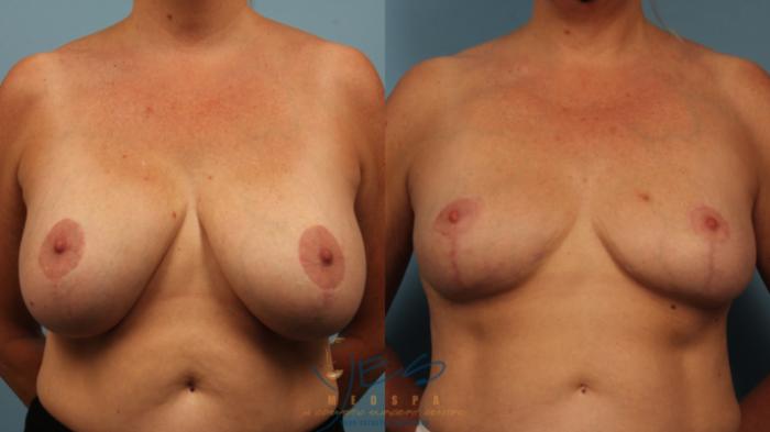 Before & After Breast Implant Removal Case 473 Front View in Vancouver, BC
