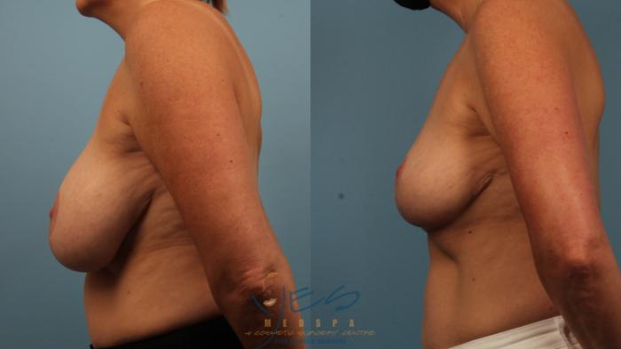 Before & After Breast Lift Case 473 Left Side View in Vancouver, BC