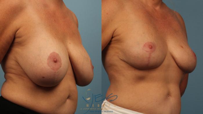 Before & After Breast Lift Case 473 Right Oblique View in Vancouver, BC
