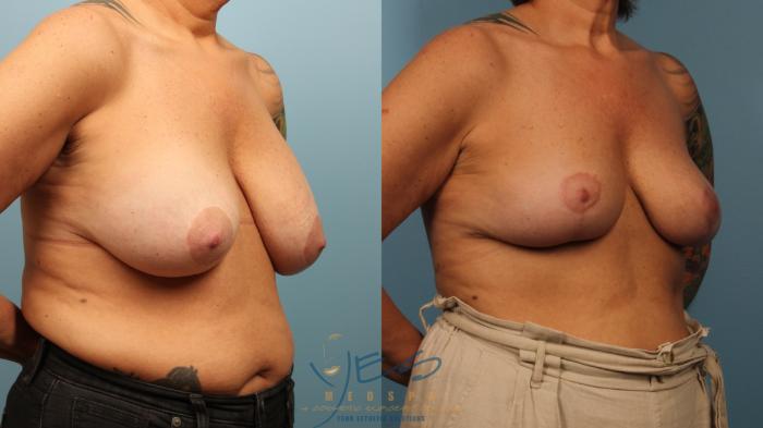Before & After Breast Lift Case 475 Right Oblique View in Vancouver, BC