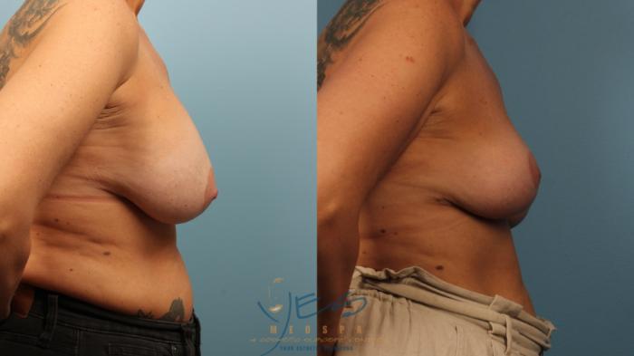 Before & After Breast Lift Case 475 Right Side View in Vancouver, BC