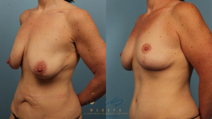 Before & After Breast Lift Case 487 Left Oblique View in Vancouver, BC