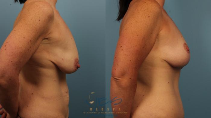 Before & After Breast Lift Case 487 Right Side View in Vancouver, BC