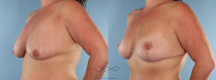 Before & After Breast Lift Case 492 Left Oblique View in Vancouver, BC