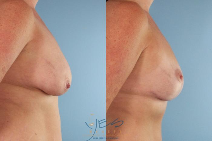 Before & After Breast Lift Case 492 Right Side View in Vancouver, BC