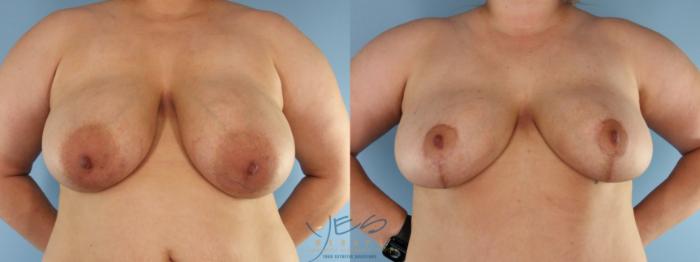 Before & After Breast Lift Case 584 Front View in Vancouver, BC