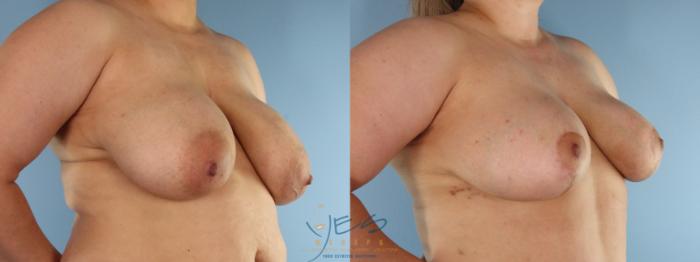 Before & After Breast Lift Case 584 Right Oblique View in Vancouver, BC