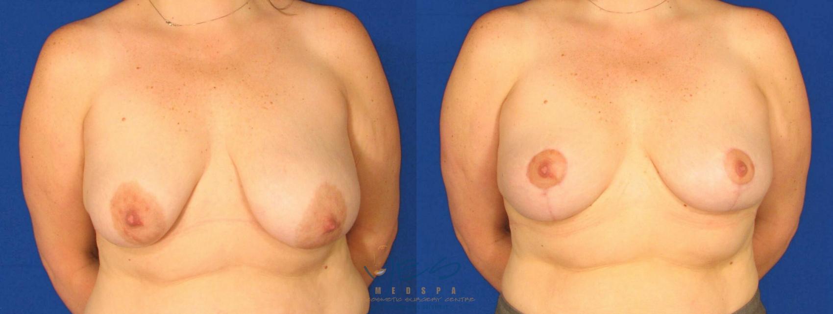 Before & After Breast Lift Case 64 View #1 View in Vancouver, BC