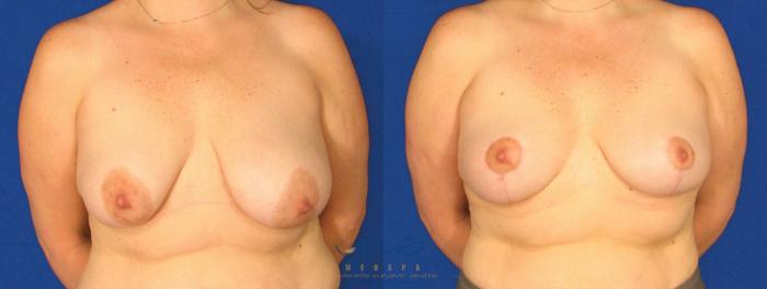 Before & After Breast Lift Case 64 View #1 View in Vancouver, BC