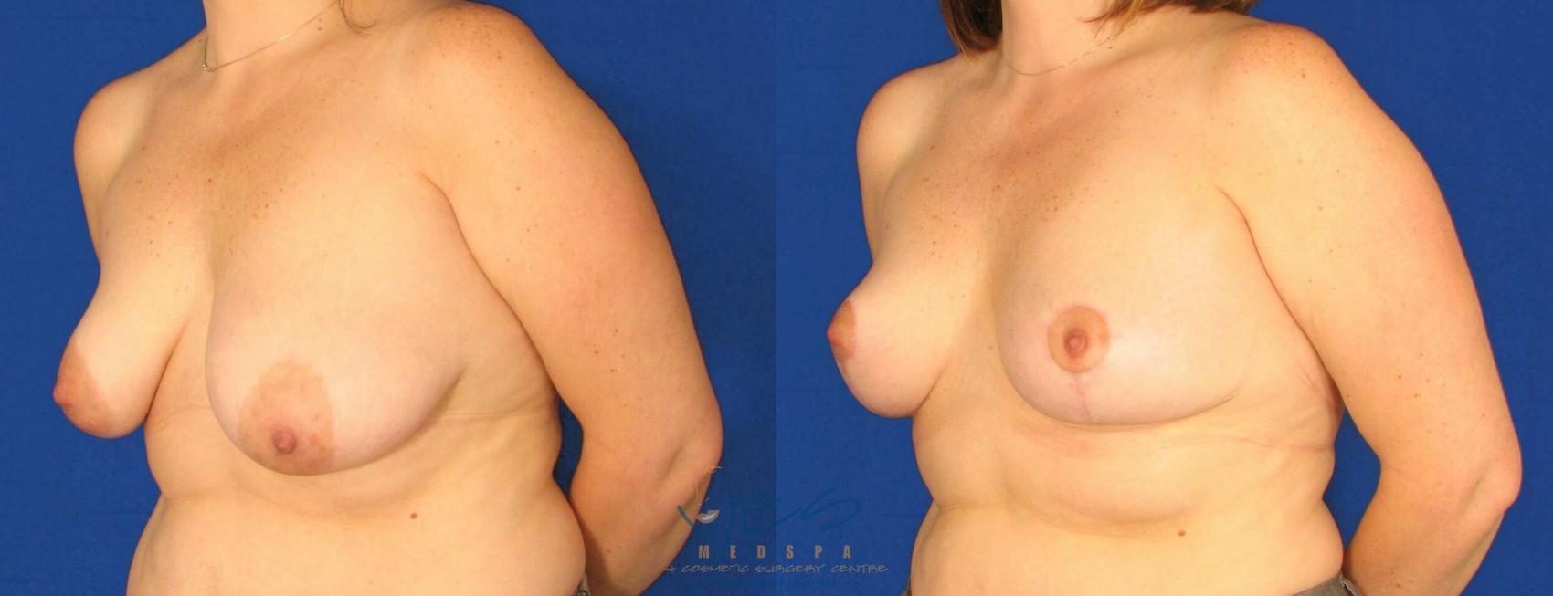 Before & After Breast Lift Case 64 View #2 View in Vancouver, BC