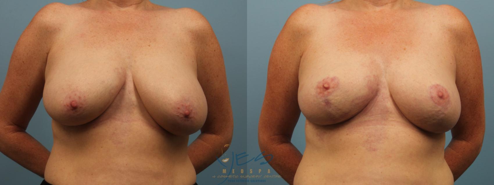 Before & After Breast Lift Case 295 Front View in Vancouver, BC