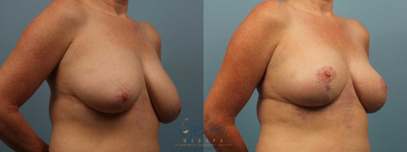 Before & After Breast Lift Case 295 Right Oblique View in Vancouver, BC