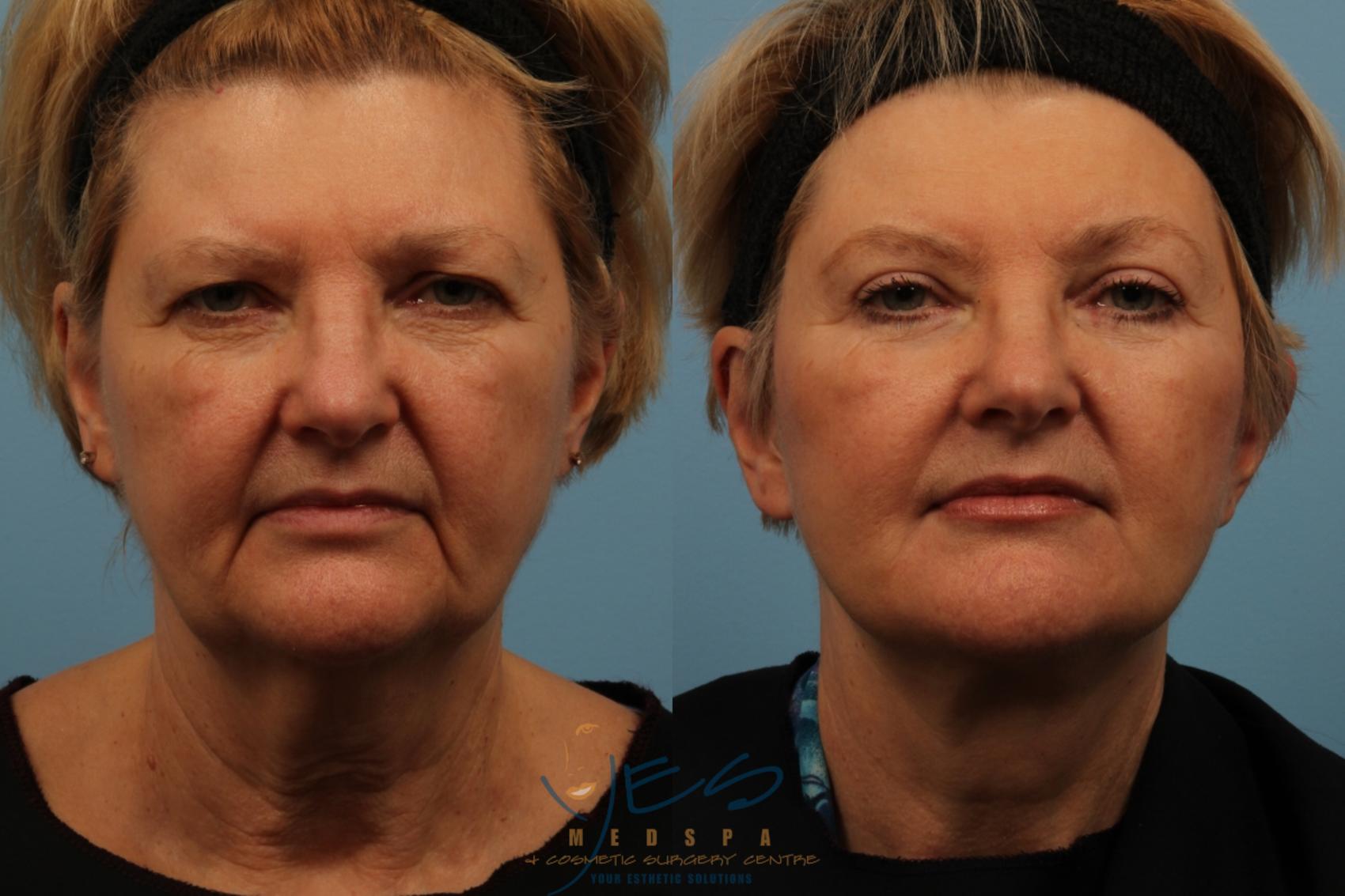 Brow Lift Before & After Photos Patient 168 | Vancouver, BC | YES ...