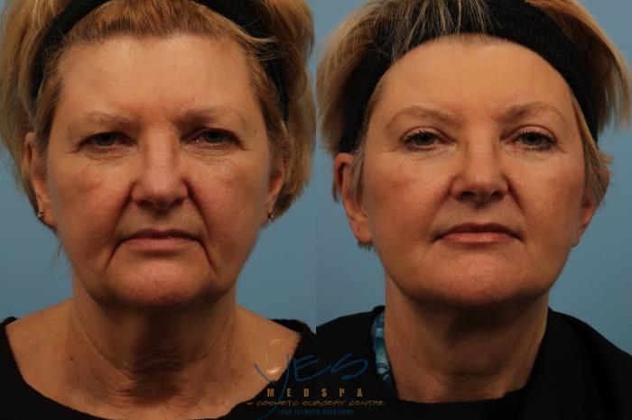 Before & After Brow Lift Case 168 View #1 View in Vancouver, BC