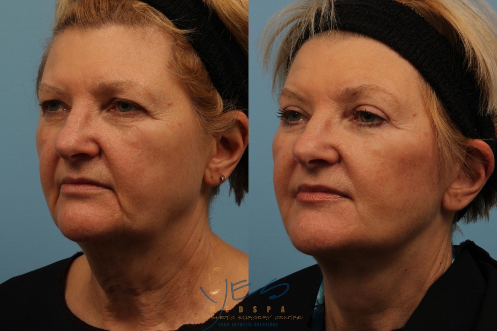 Before & After Brow Lift Case 168 View #2 View in Vancouver, BC